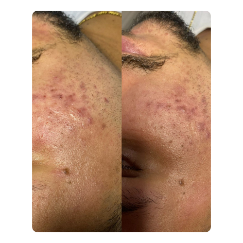 Limpeza de pele